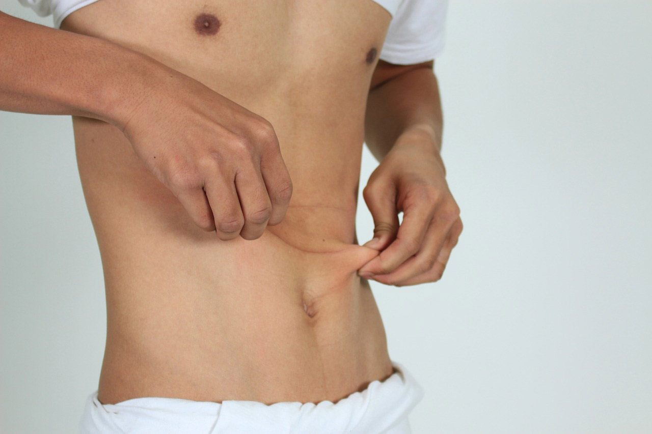 Pubic lift (monsplasty) to reveal hidden penile length in New York and New Jersey with Dr. Elliot Heller
