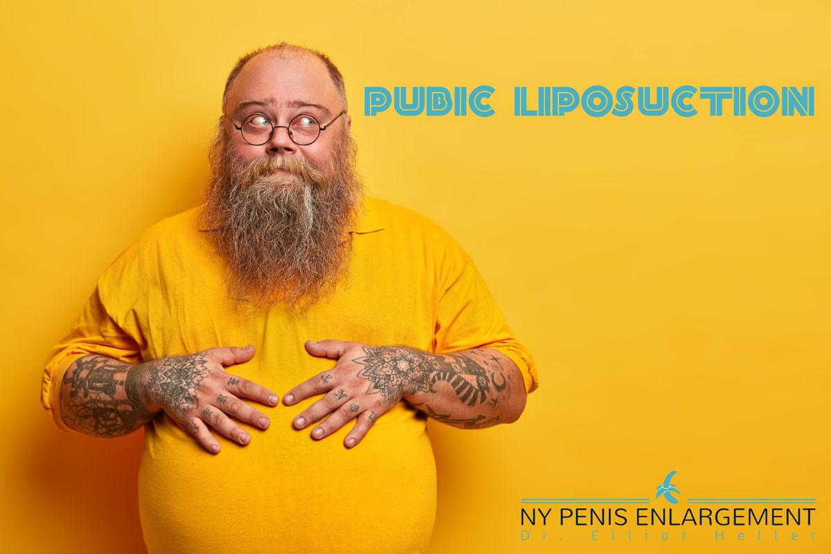 Pubic Liposuction